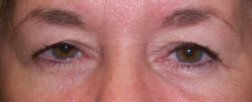 Cosmetic eyelid surgery, Blepharoplasty, Eyelift