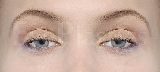 Before and after images of a 58-year-old patient showing results of ptosis and blepharoplasty surgery from the national database